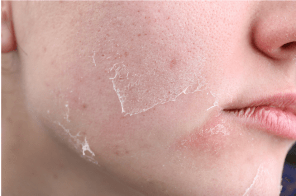 Why Your Skin Feels Worse Indoors Than Outside