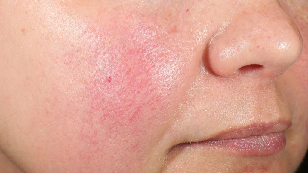 Signs Your Skin Barrier Might Be Damaged